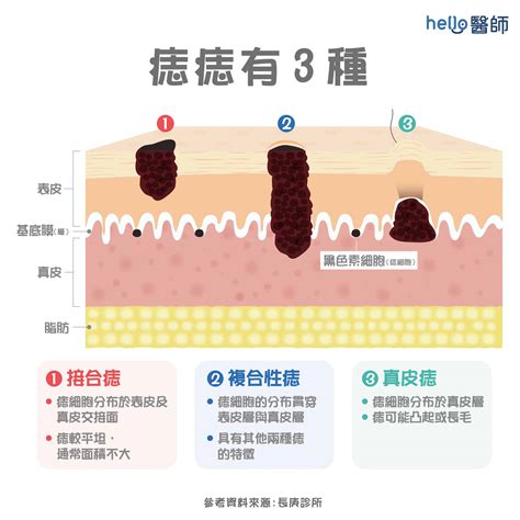 痣 形成原因